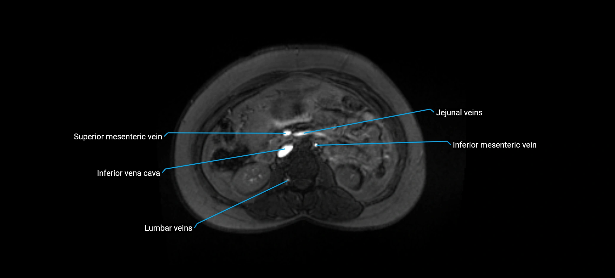 MRV abdomen pelvis & lower limb axial cross sectional anatomy labelled MRI image 78 (1).webp